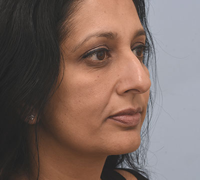 Before Rhinoplasty surgery