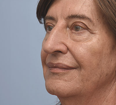 Before Rhinoplasty Surgery