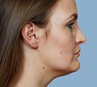After Rhinoplasty